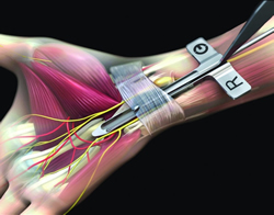 Endoscopic Carpal Tunnel Release